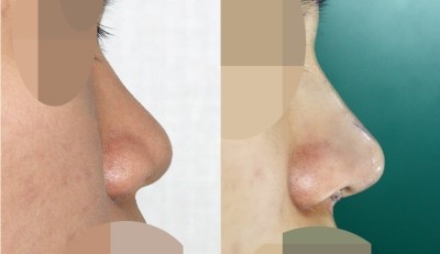 복코성형 (콧대+코끝성형) 관련 이미지 1