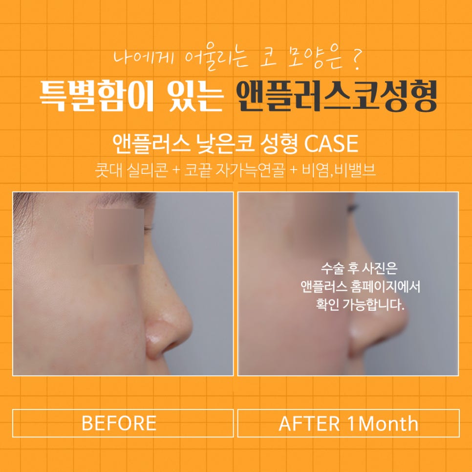 Nasal Bridge Surgery That Also Improved Rhinitis image 12