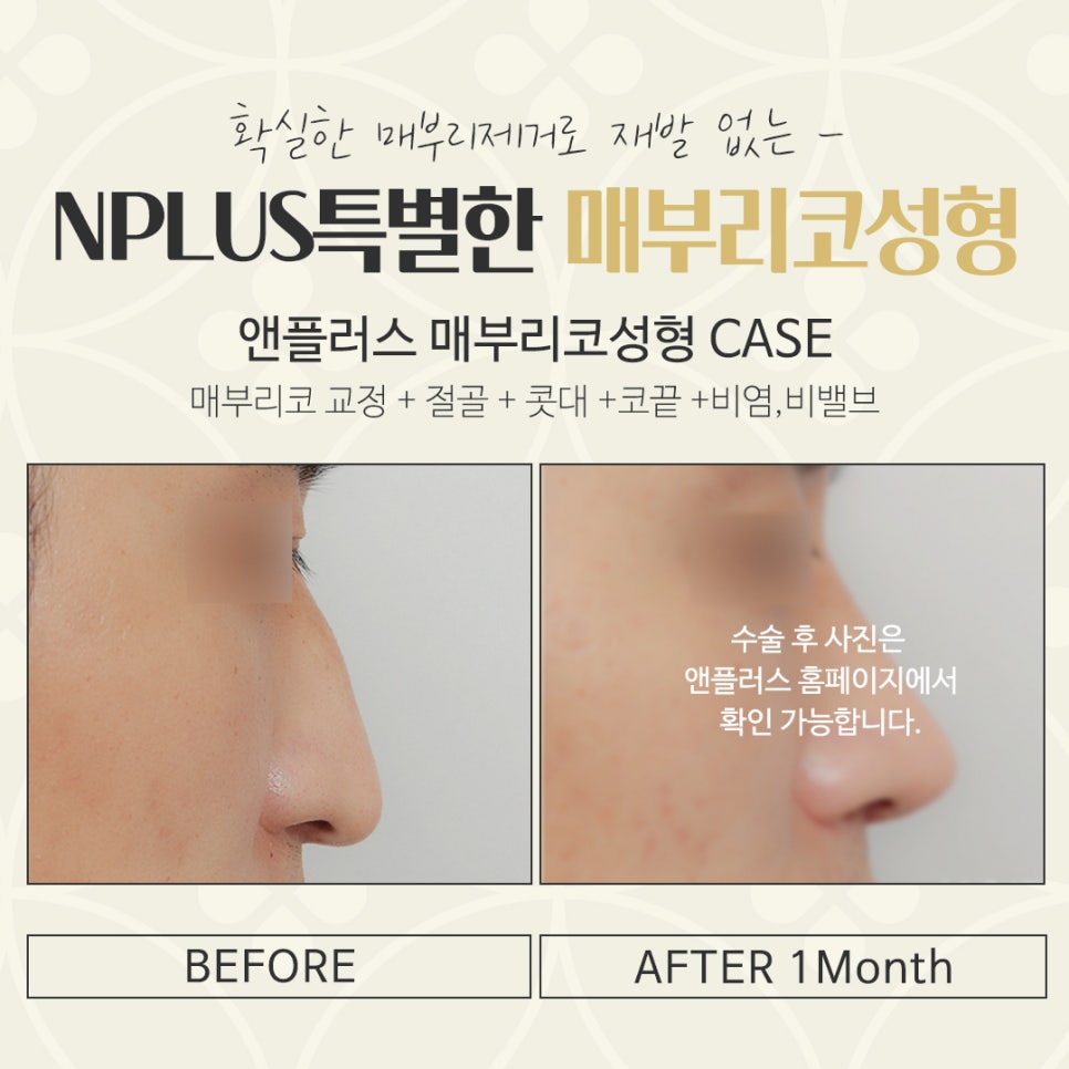 매부리코수술후기 확인하고 부드러운 인상으로 관련 이미지 17