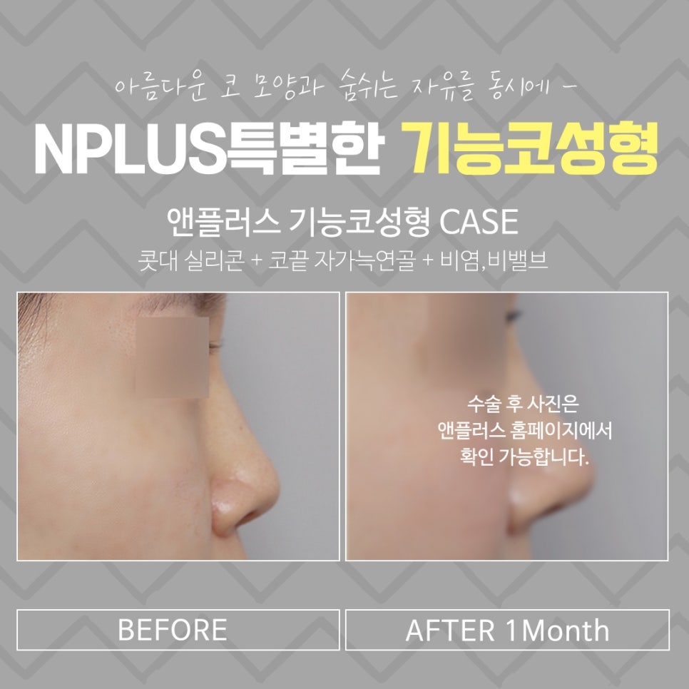 기능코성형을 통한 한쪽 코막힘 개선 관련 이미지 14