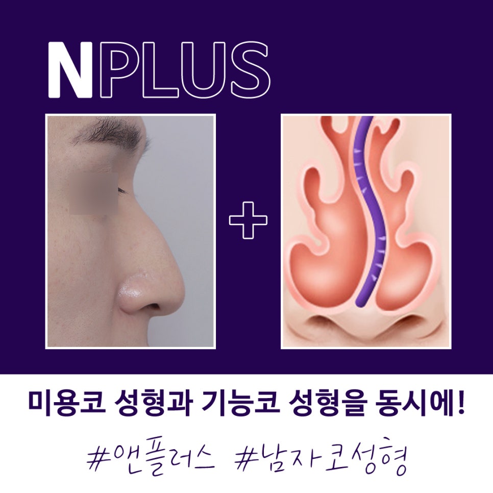 오지코성형외과_남자성형전후 만족스러운 결과 관련 이미지 2