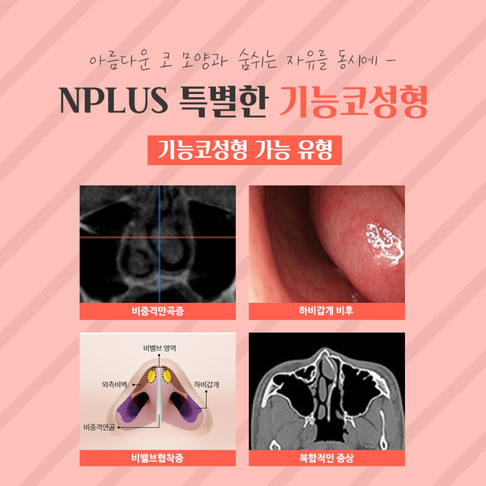 Female Rhinoplasty Review: A Line That Suits You image 7