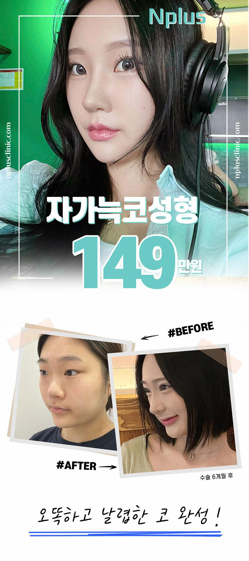 자가늑연골코성형비용에 대해 알아본다면?! 관련 이미지 2