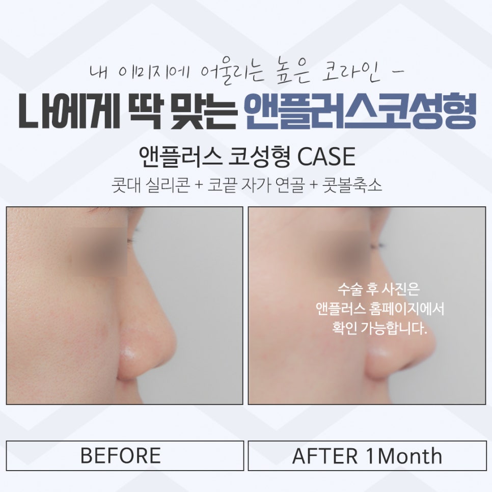 압구정코성형 자세하게 알아보고 관련 이미지 13
