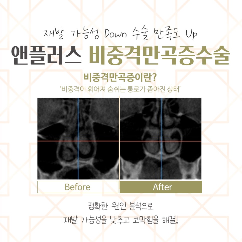 Septoplasty Surgery Review: Accurately Identifying the Cause image 4