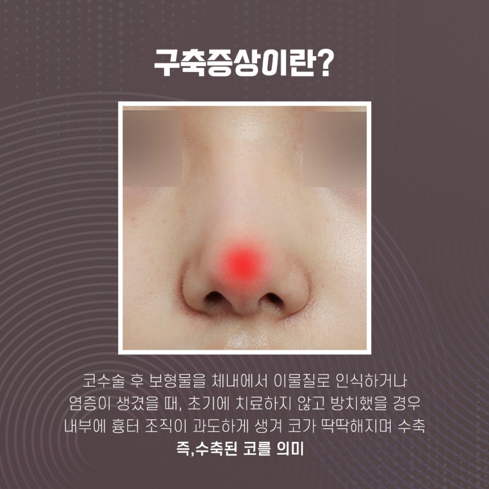 If You Develop Contracted Nose, Check Out Nose Revision Surgery Reviews! image 4