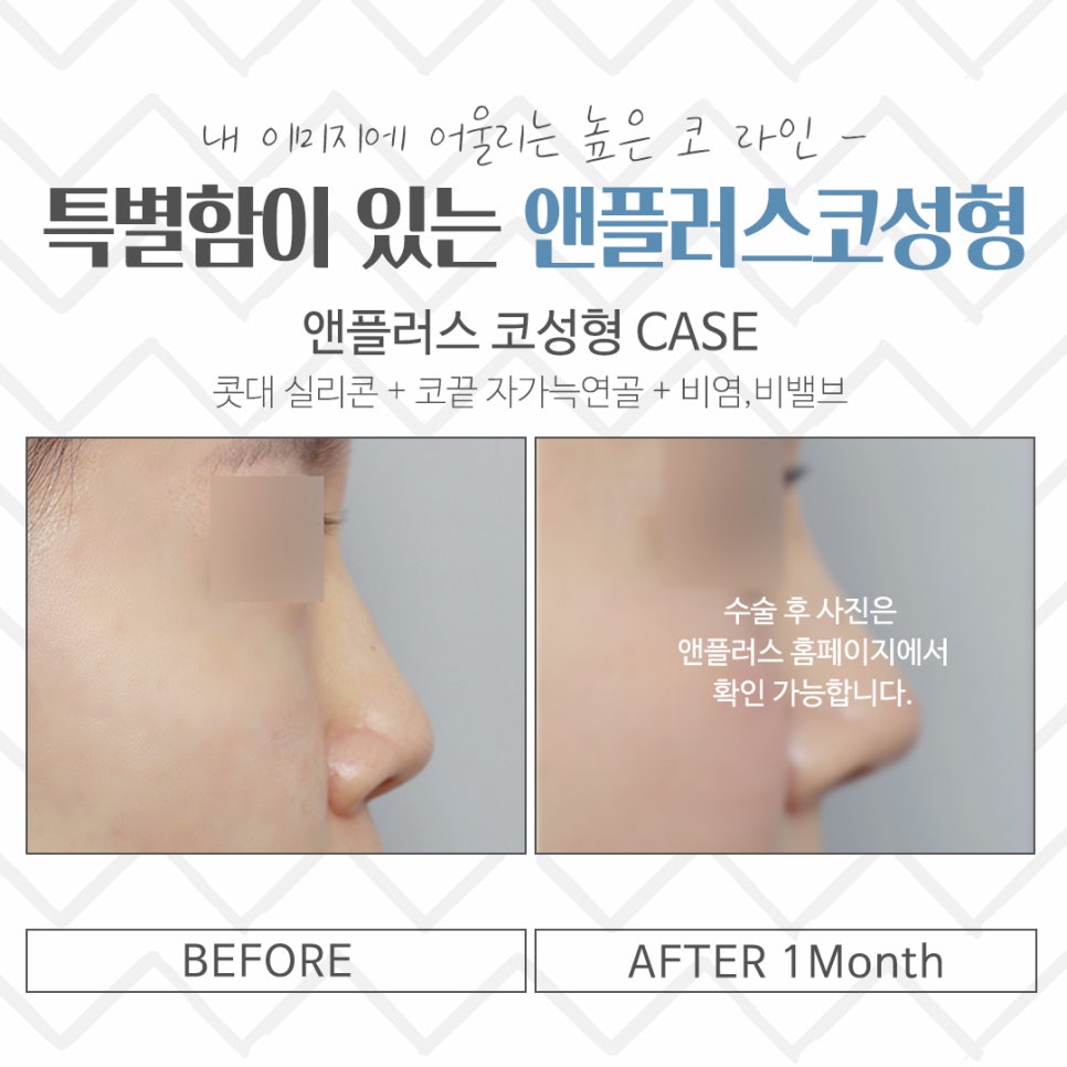 Nose Surgery Review: A Thorough Look Inside image 17