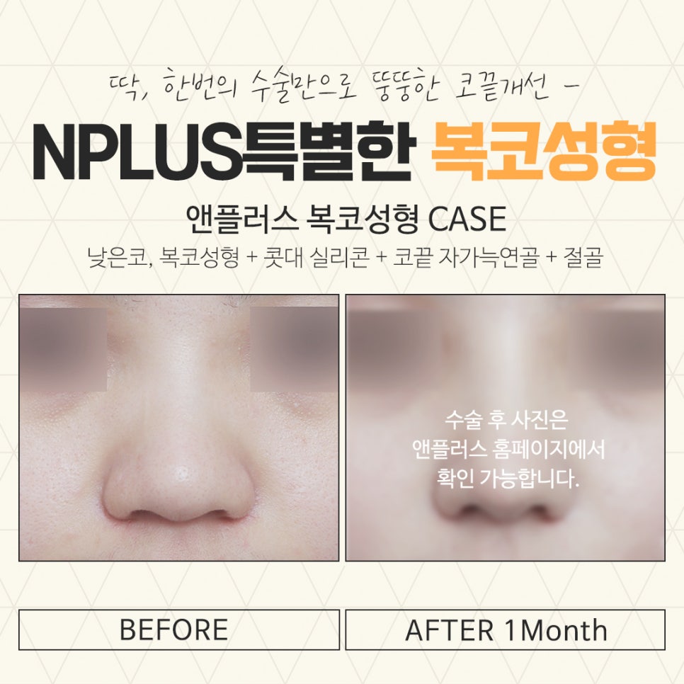 복코수술후기 정확한 진단을 통하여 관련 이미지 15