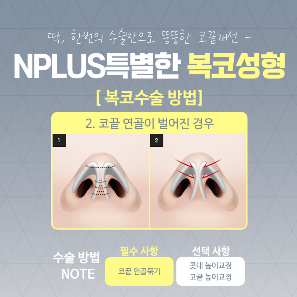 복코수술후기 조화로운 얼굴 라인 관련 이미지 7