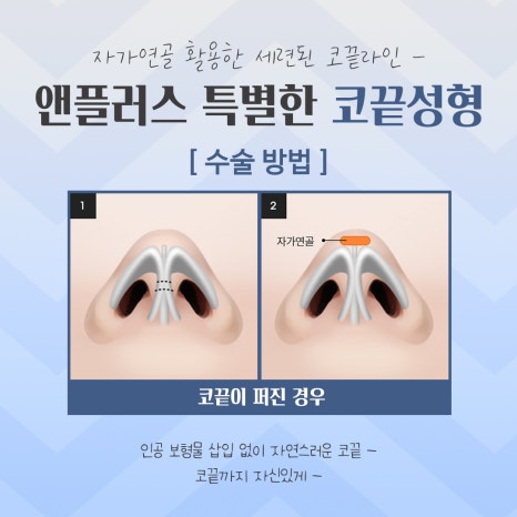 Looking into Comparisons of Tip Rhinoplasty Reviews image 9