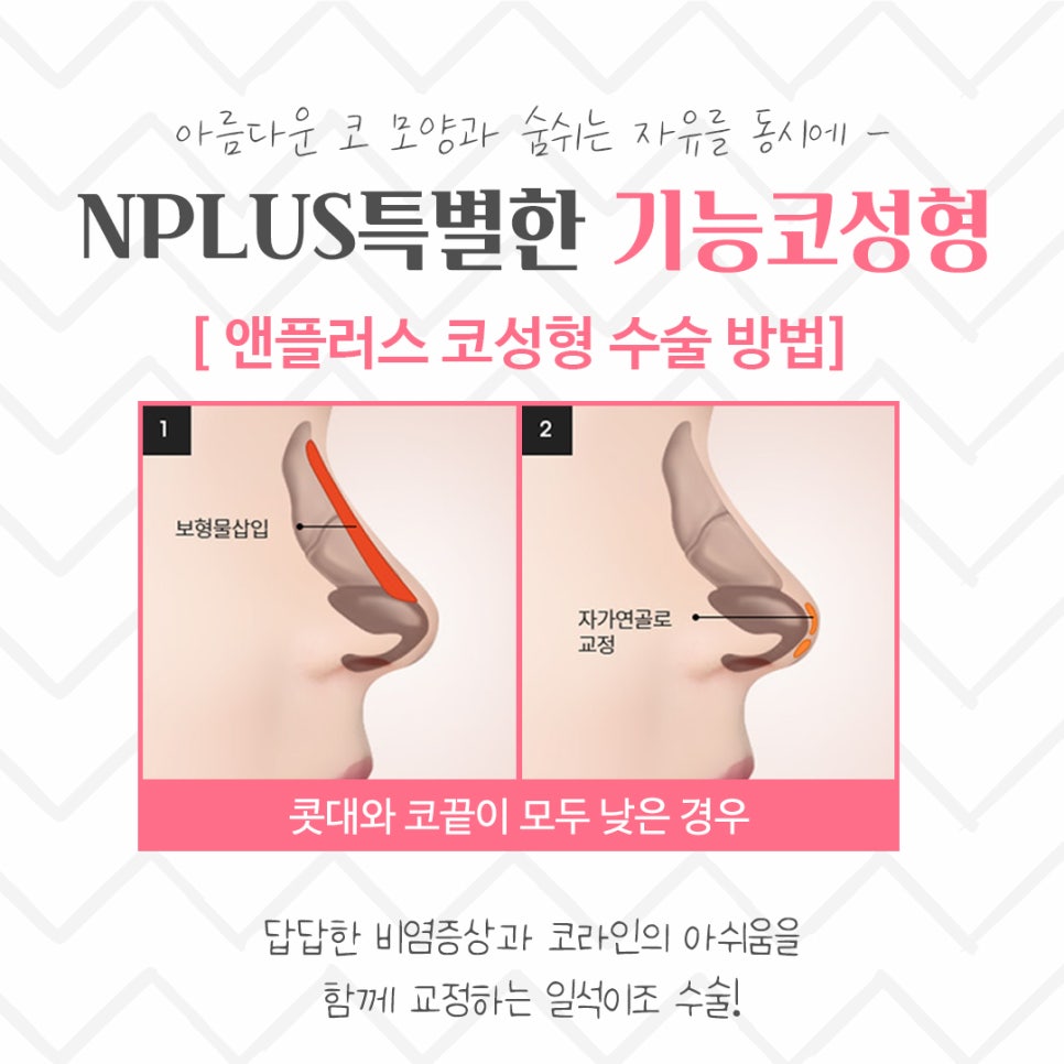 기능코성형후기 원인 파악을 확실하게 관련 이미지 10