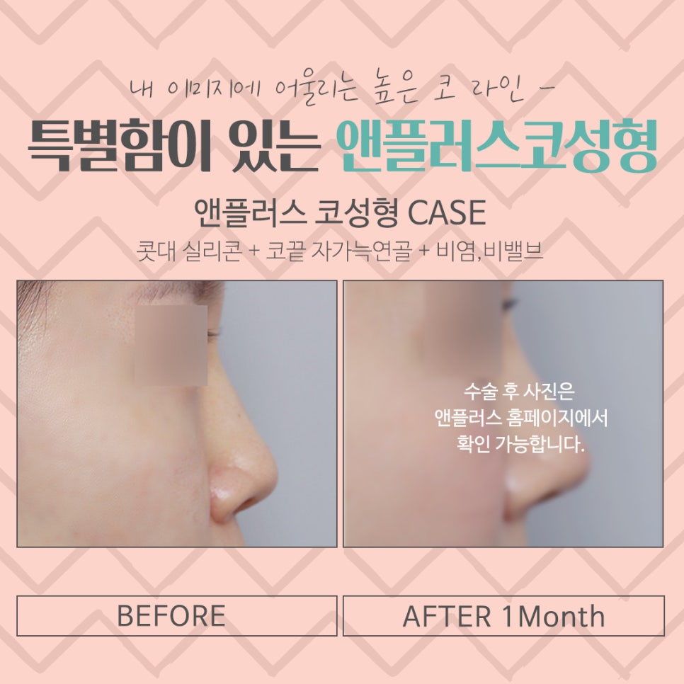 Nose Surgery Review Considering the Straight-Humped, Straight-Half-Moon Line image 18