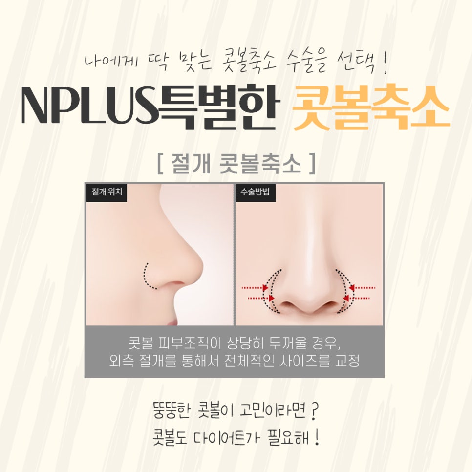 콧볼축소후기 자세하게 확인하여 관련 이미지 9