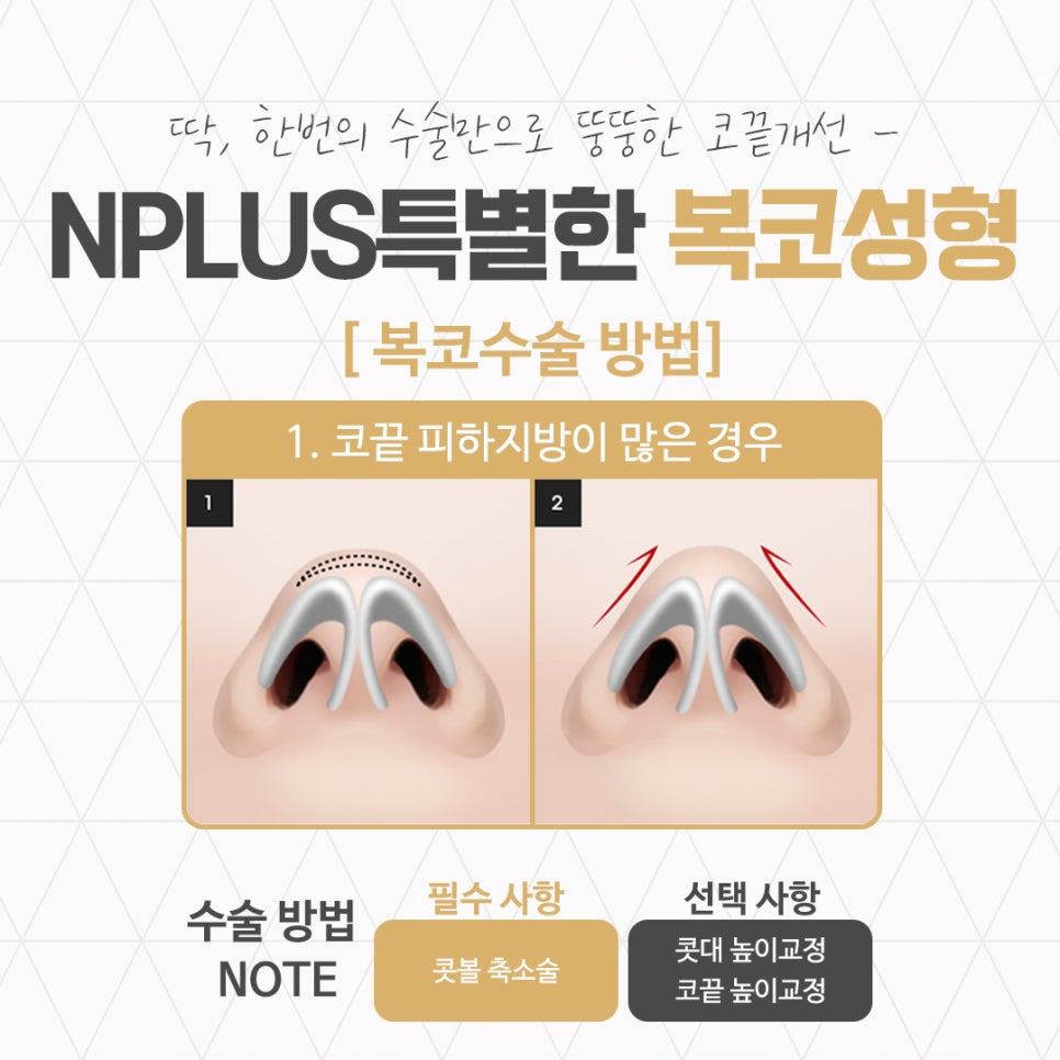 Taking a Thorough Look at Bulbous Nose Surgery Reviews image 7
