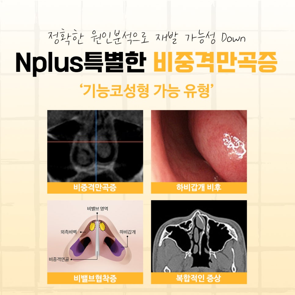 비중격만곡증수술후기에 대해 신중하게 찾아보고 관련 이미지 5