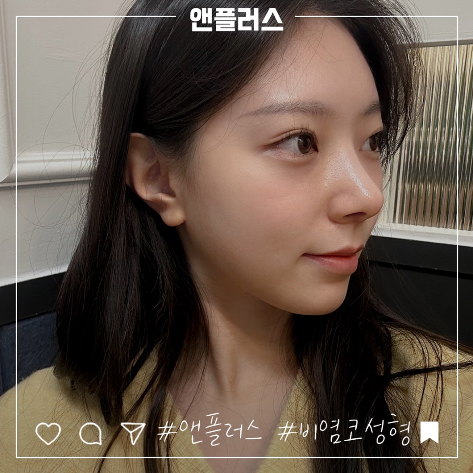 앤플러스에서 진행된 비염수술코성형에 대하여 관련 이미지 2