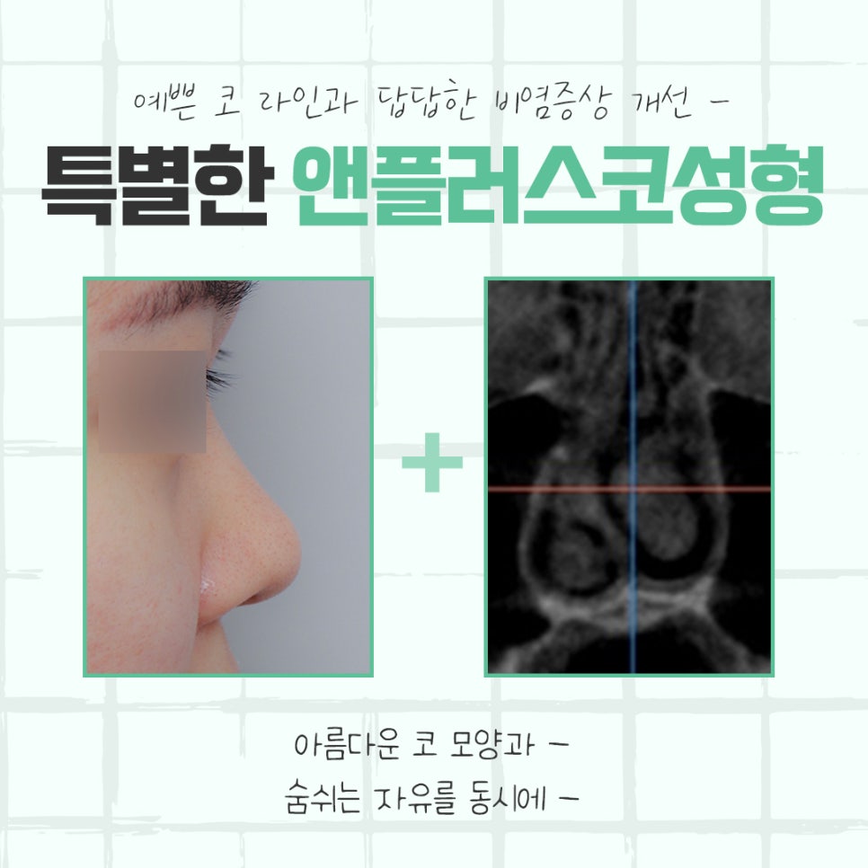 Learn in Detail About Nose Surgery in Gangnam image 5