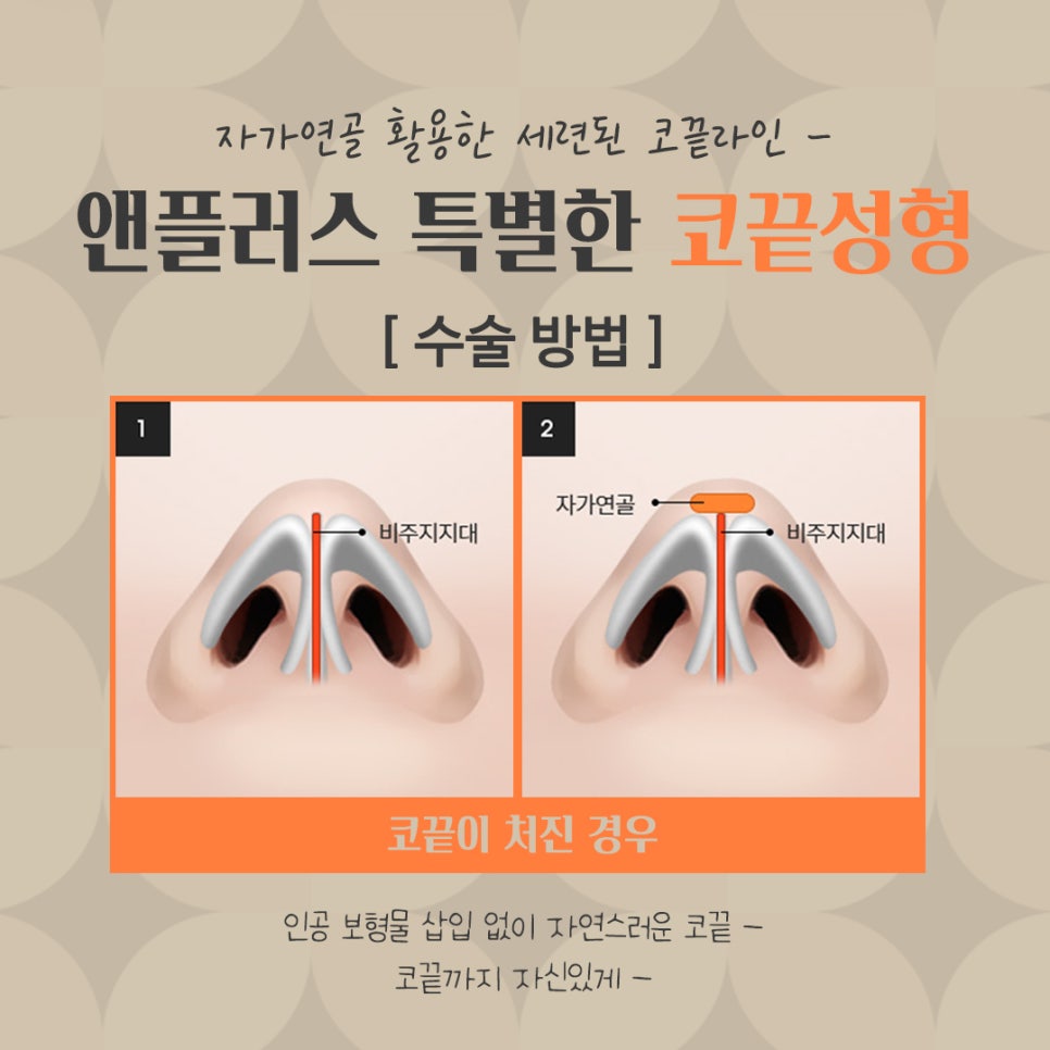 코끝수술후기 자가연골로 안전하게 관련 이미지 8