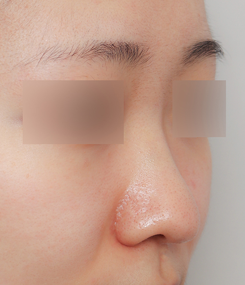 Creating a Straight-But-Slightly-Curved Nose Line with Columella Reduction image 4