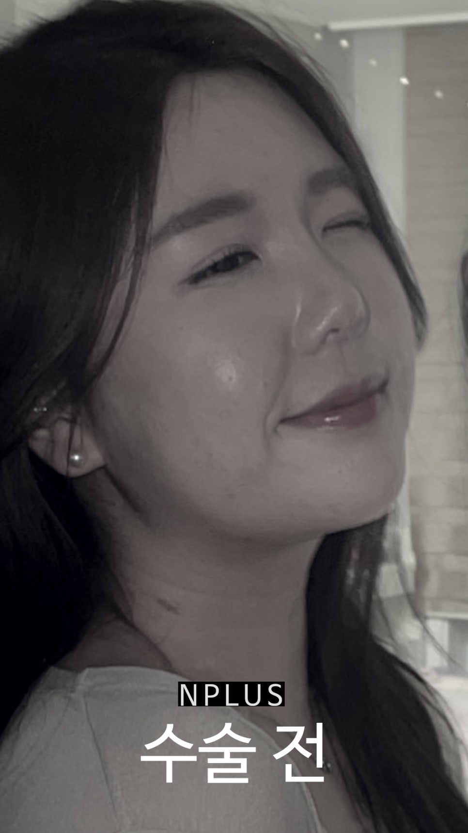 Short and Upturned Nose Shape Corrected with Autologous Rib Cartilage Nose Surgery at N Plus Clinic! image 2