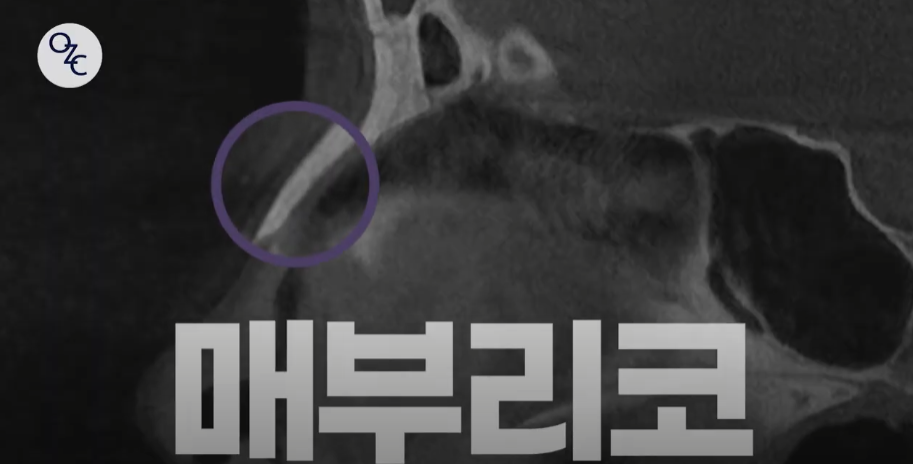 코뼈골절의 원인과 수술 방법에 대하여 관련 이미지 12