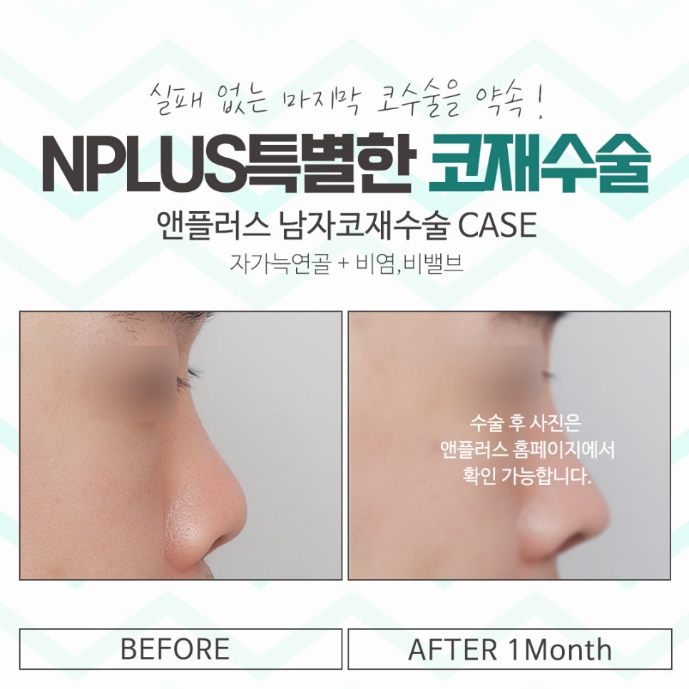 Male Nose Revision Surgery with a Thorough Diagnosis image 15