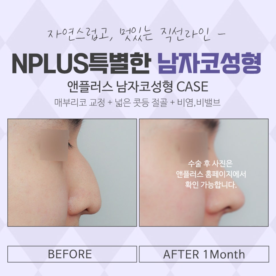 남자코성형후기 내부까지 확인하여 관련 이미지 14