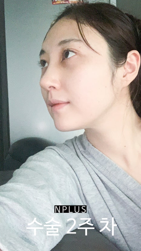 앤플러스에서 진행된 매부리코성형후기 관련 이미지 4