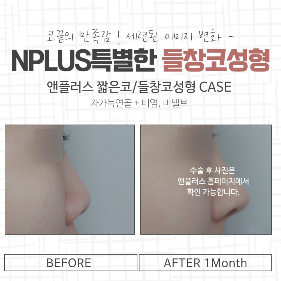 들창코성형 선택의 중요성 관련 이미지 15