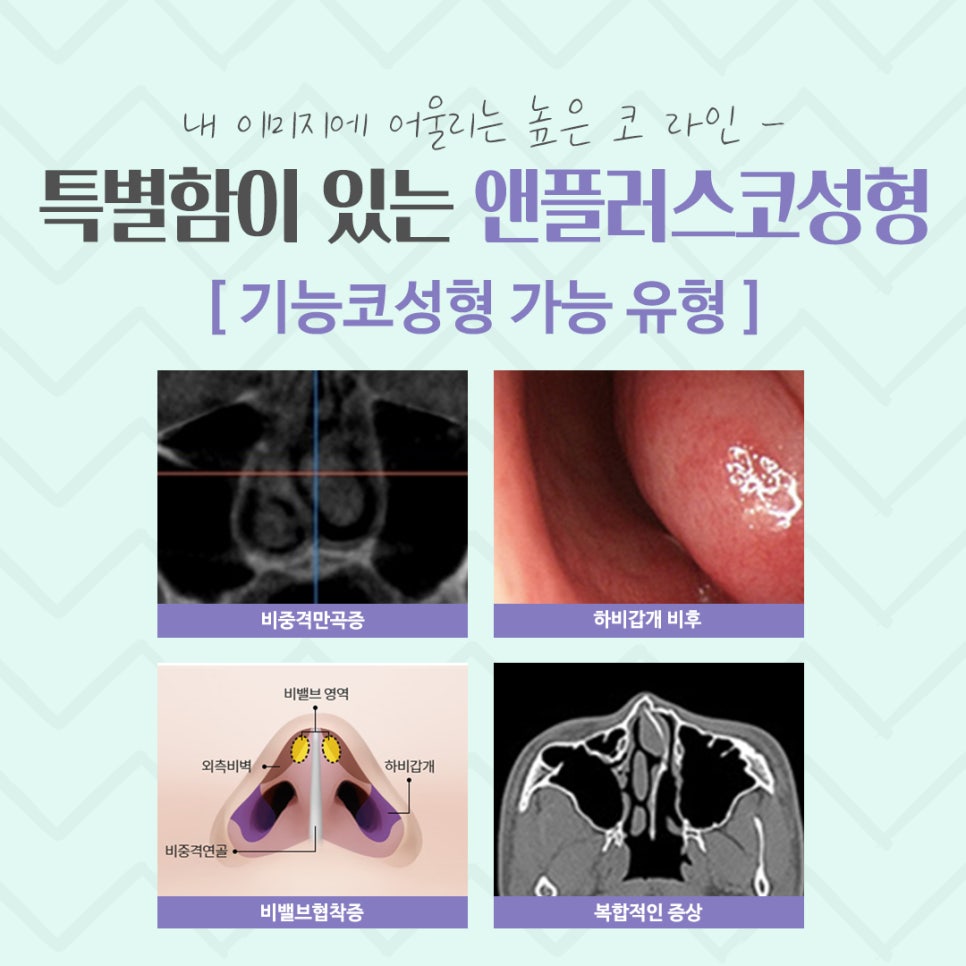 Rhinoplasty Review Considering Functional Aspects image 5