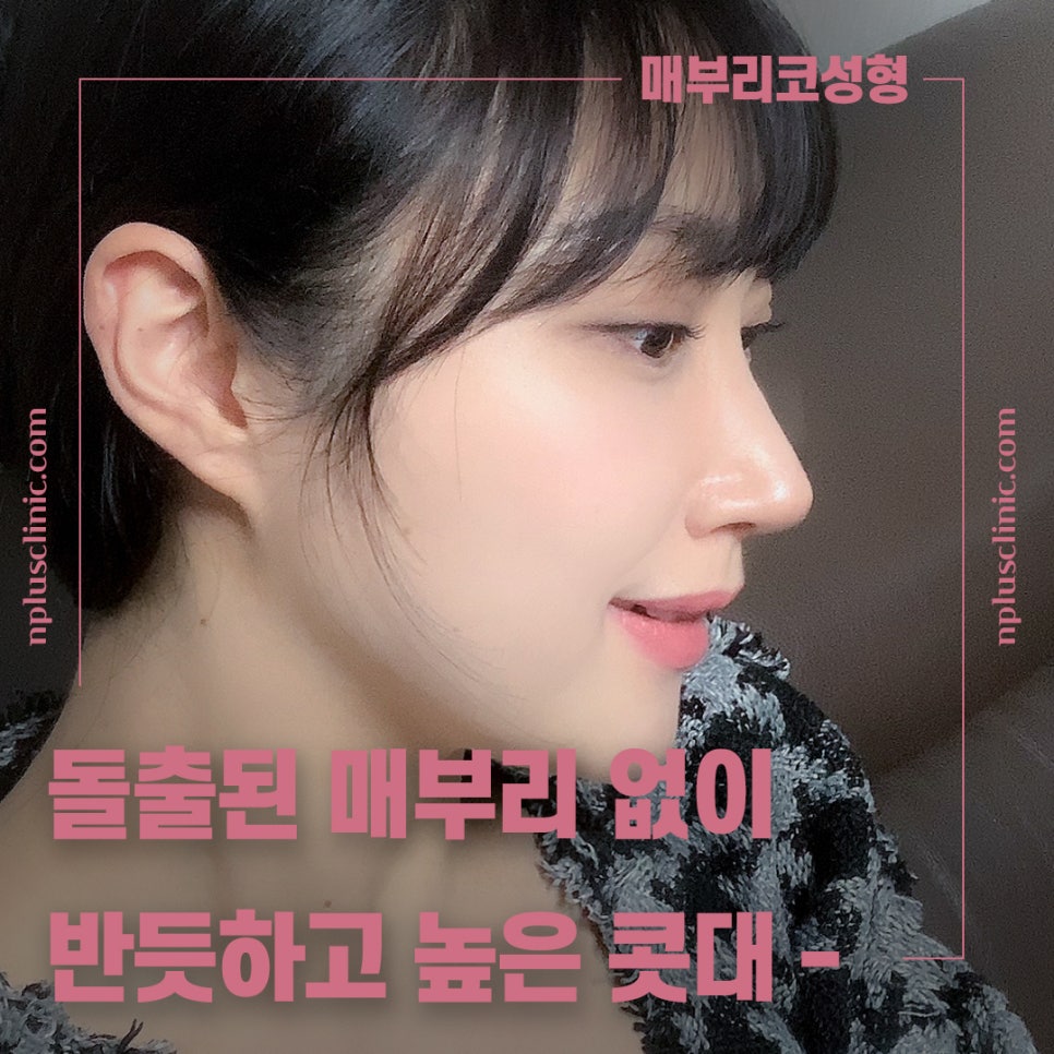 🍁가을엔 앤플러스의원 코성형 이벤트🍁 관련 이미지 4