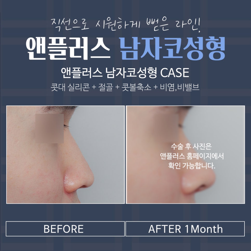 A Sophisticated Image Transformation Before and After Male Nose Surgery image 11