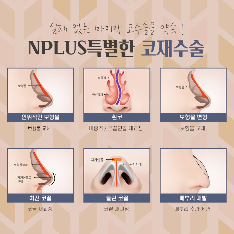 자가늑연골 활용한 코재수술후기 관련 이미지 4
