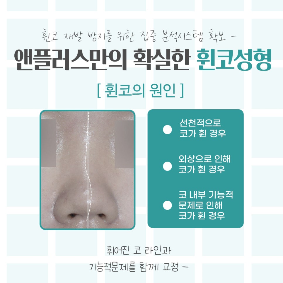 Understanding the Issues in Crooked Nose Surgery Accurately image 4