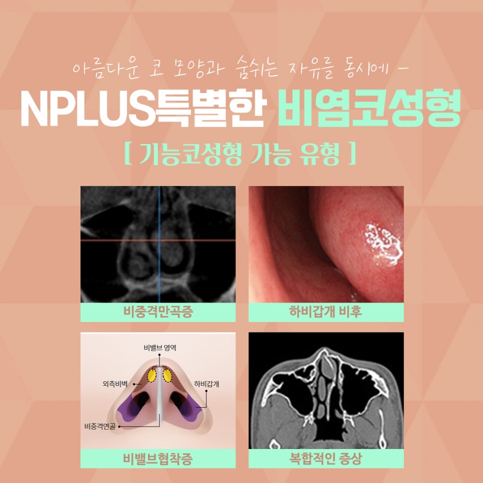 Nasal Surgery Review, Considering a Beautiful Nose Line image 7