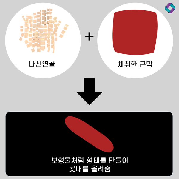 늑연골 코성형 : 자가연골의 장점과 단점 (자가연골 비교) 관련 이미지 12