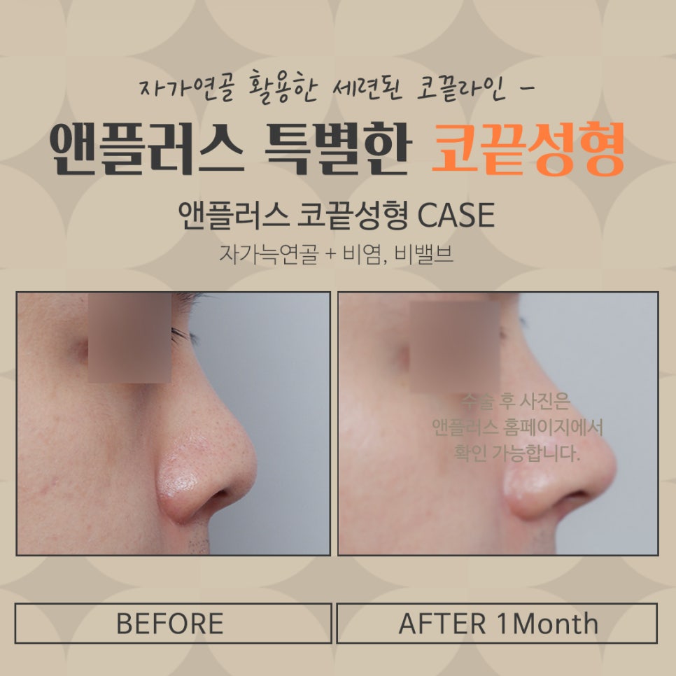 코끝수술후기 자가연골로 안전하게 관련 이미지 5