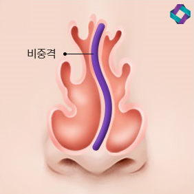 기능코성형 비중격만곡증(비중격교정술)과 코막힘원인 관련 이미지 2