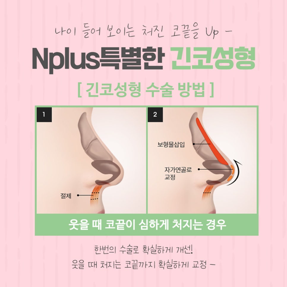 긴코성형으로 교정하고 동안 되자 관련 이미지 10