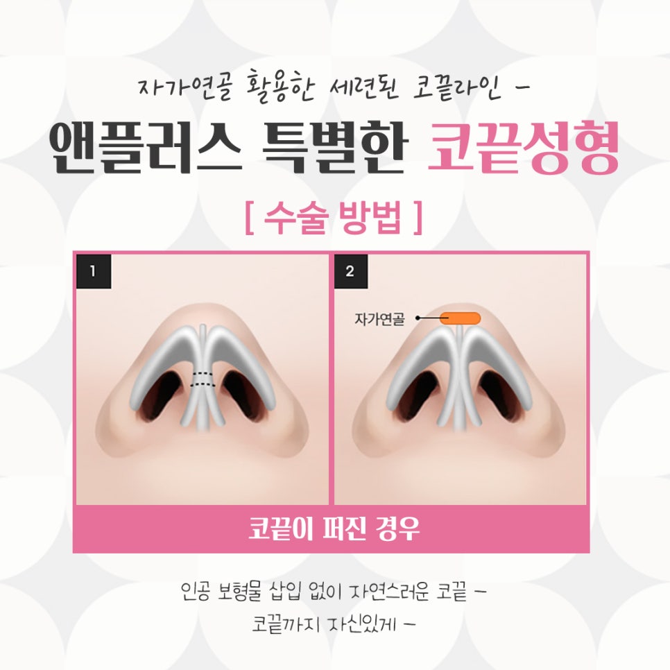 코끝수술후기의 다양함을 알아보고 관련 이미지 10