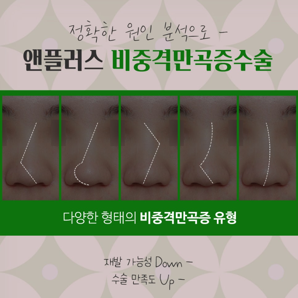 비중격만곡증 수술방법 확인하여 관련 이미지 6