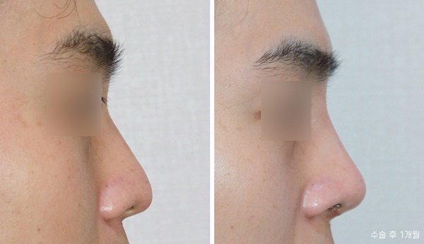 Male Nose Surgery Before and After: Tip Correction image 3