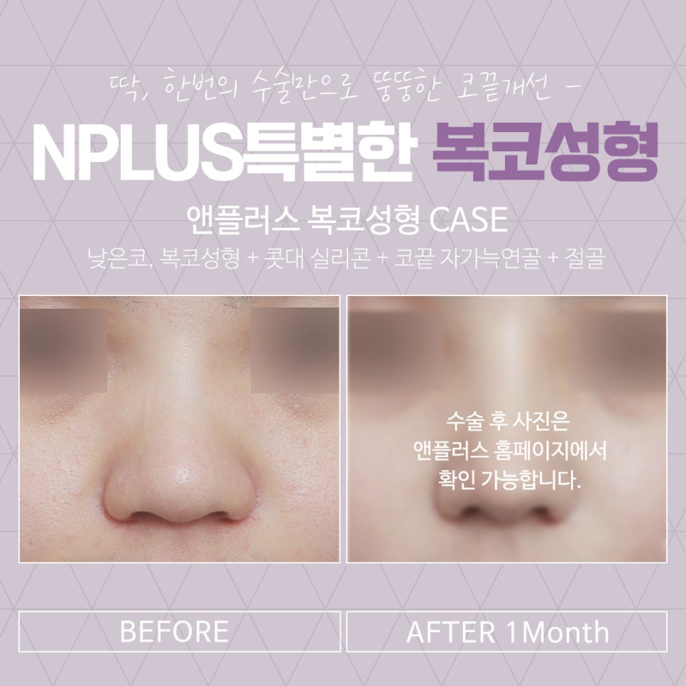 복코수술후기 슬림한 라인으로 관련 이미지 15