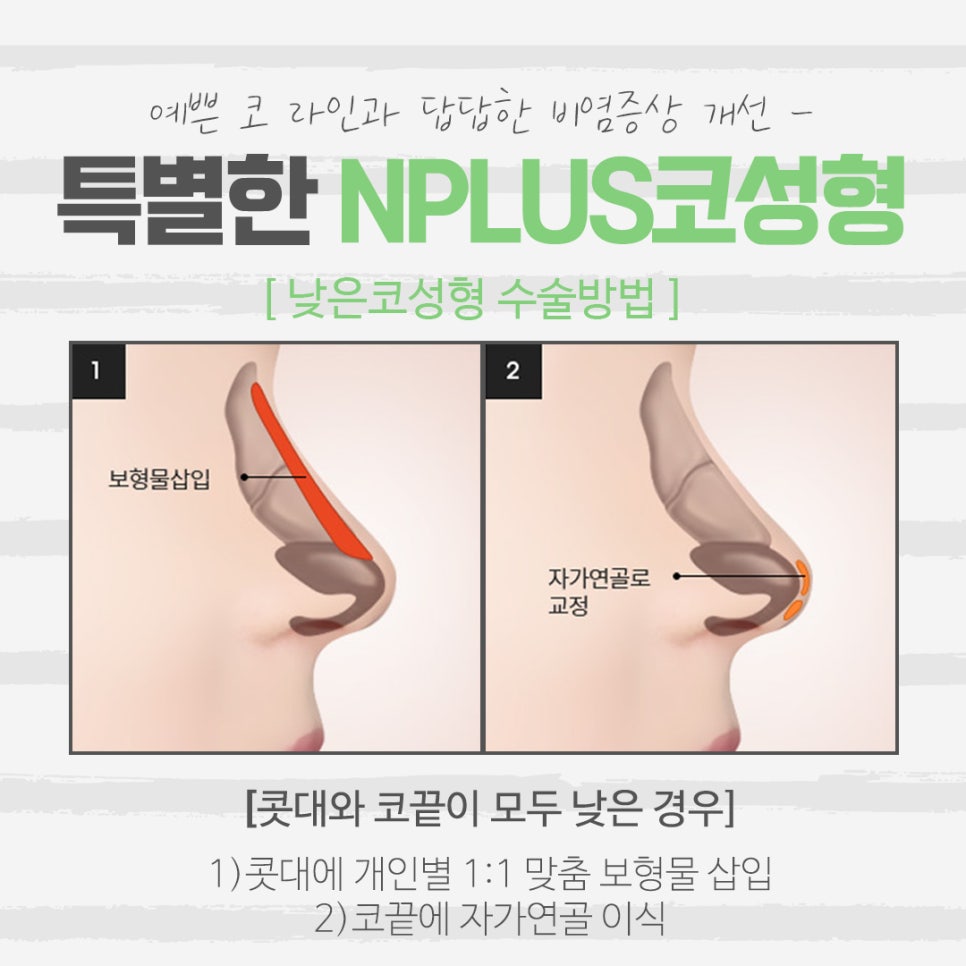 낮은코성형 후기에 대해 알아보고 관련 이미지 7