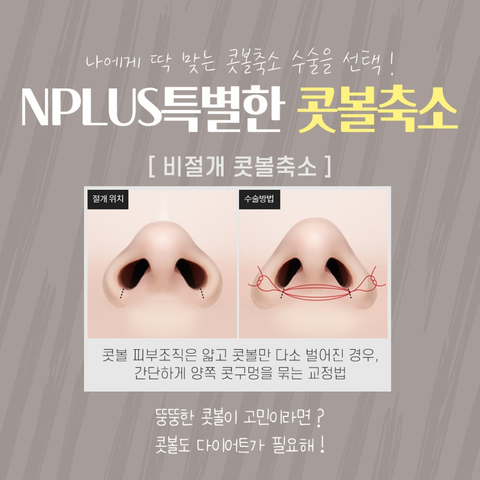 Postoperative Review of Nostril Reduction Surgery: If You’re Worried About Wide Nostrils image 9