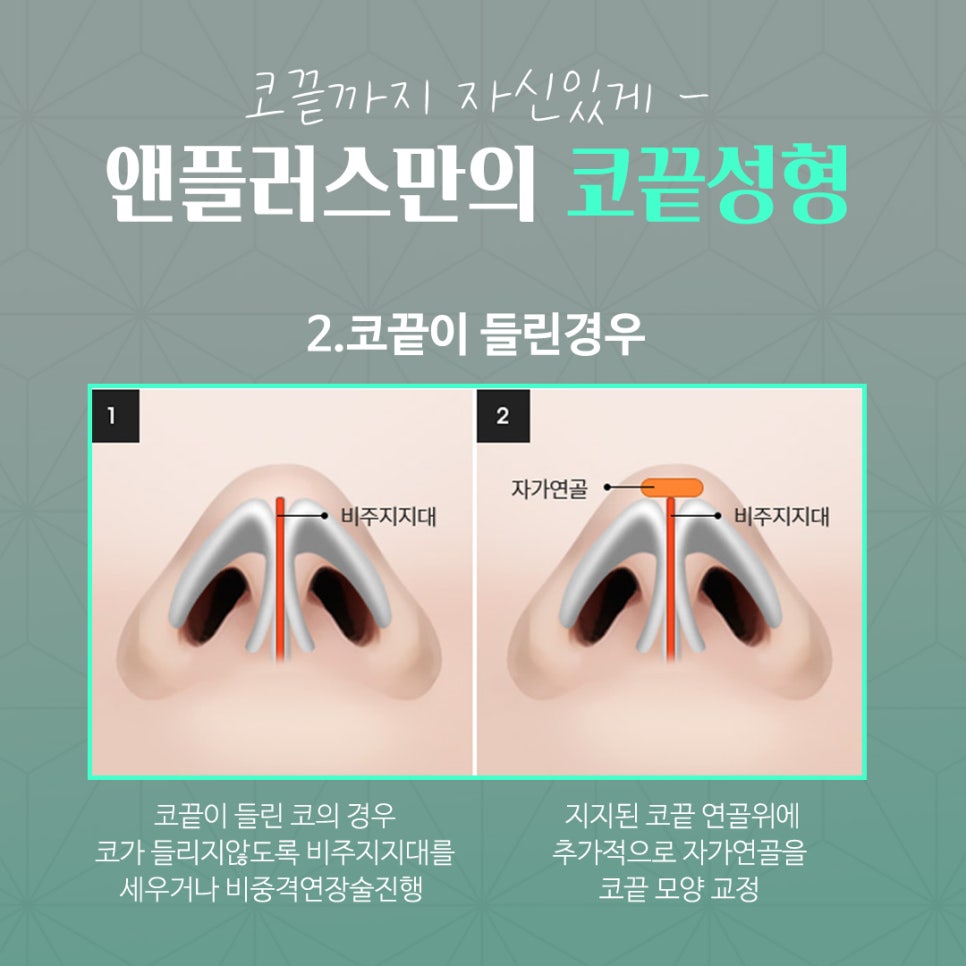 Improving the line through tip cartilage suturing image 8