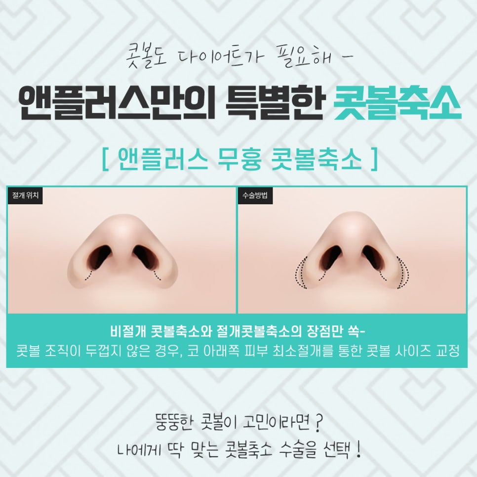 콧볼축소수술후기의 차이를 비교해 보고 관련 이미지 7