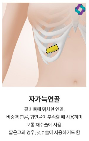 늑연골 코성형 : 자가연골의 장점과 단점 (자가연골 비교) 관련 이미지 6