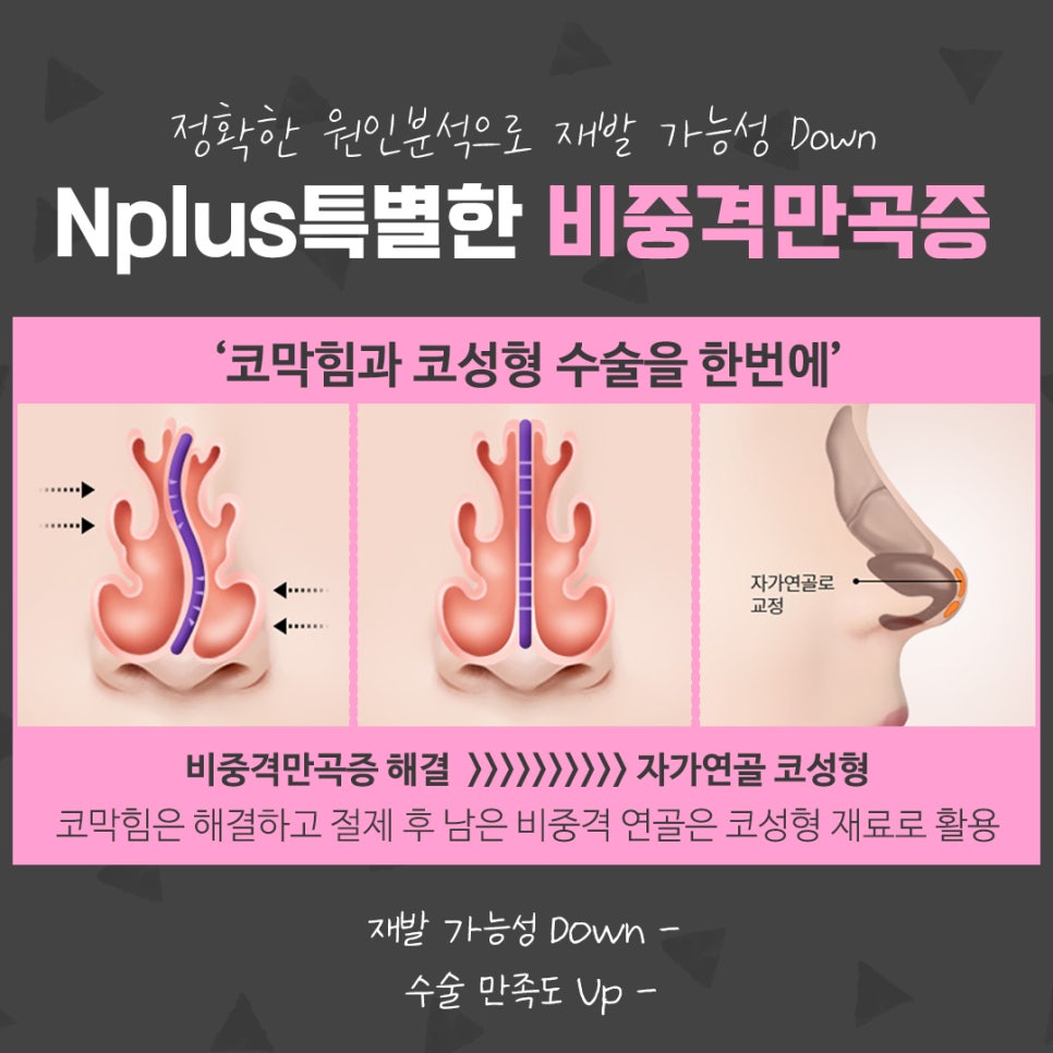비중격만곡증수술 신중한 선택으로 관련 이미지 9