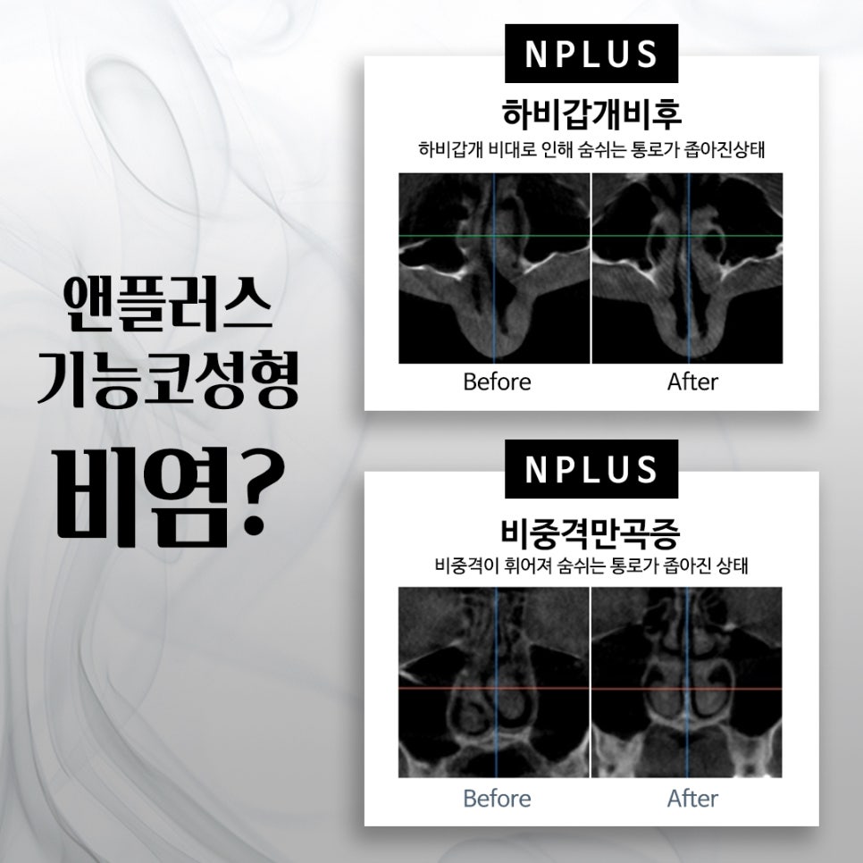 기능코성형실비에 대해 체크하고 관련 이미지 4